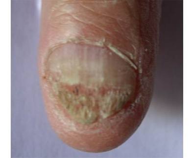 得了灰指甲就是艾滋病患者吗 2010晋中市孙被霞日常科普