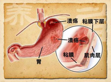 胃炎的症状有哪些 六安市王琰丽：关于胃溃疡的科普文章