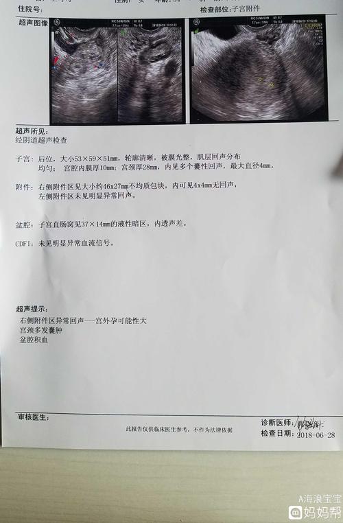 宫外孕切输卵管的疤痕 2017淮安市尹爽珠科学普及