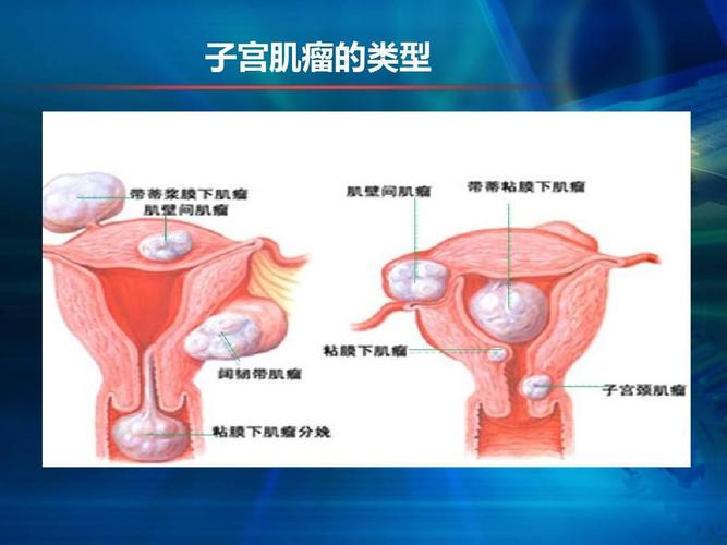 子宫肌瘤有哪些类型各有什么特点 2011锦州市褚纯秀科普文章