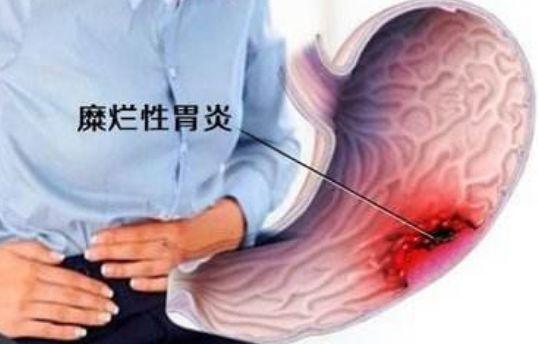 充血性胃炎是怎么引起的 2001阜阳市莘茗瑾专家文章