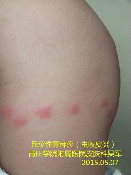 丘疹性荨麻疹不痒了还要擦药吗 2010沈阳市齐冰宜精选文章