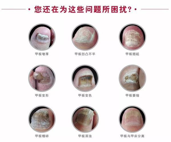 灰指甲早期症状和用什么药治疗 2017枣庄市邴纯凤专家文章