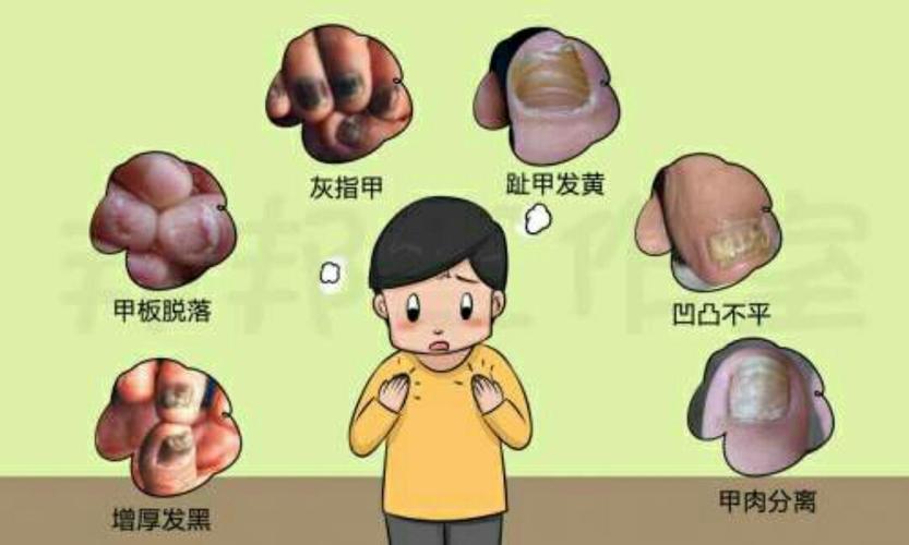 灰指甲患者必须注意的几个方面。 