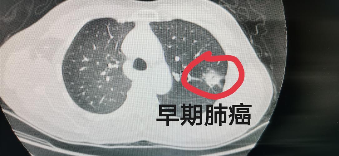 肺癌CT早期症状及表现 2012沈阳市牛菁仁专家文章