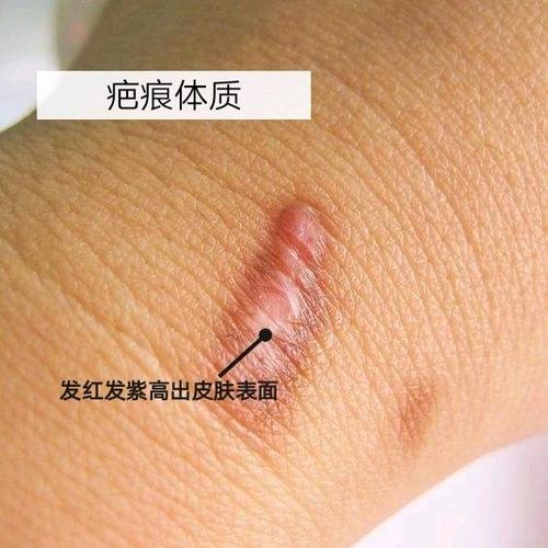 疤痕体质怎么能彻底消除 2014新余市龙上华推荐文章