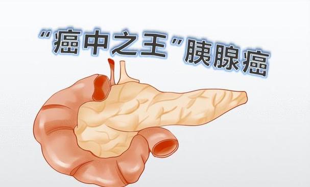 胰腺癌的早期症状胃痛 2012滨州市松昭昭专家文章